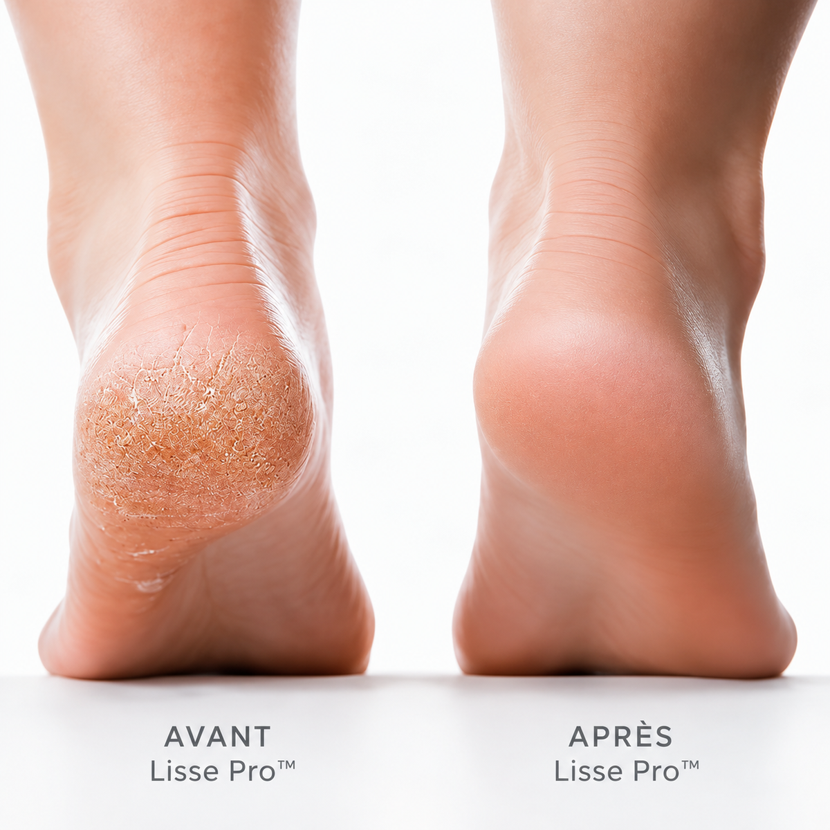 Lisse Pro™ – Soin Électrique Anti-Callosités